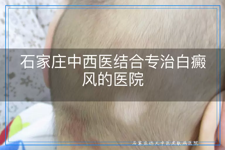 石家庄中西医结合专治白癜风的医院