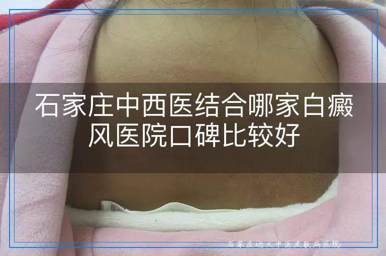 石家庄中西医结合哪家白癜风医院口碑比较好