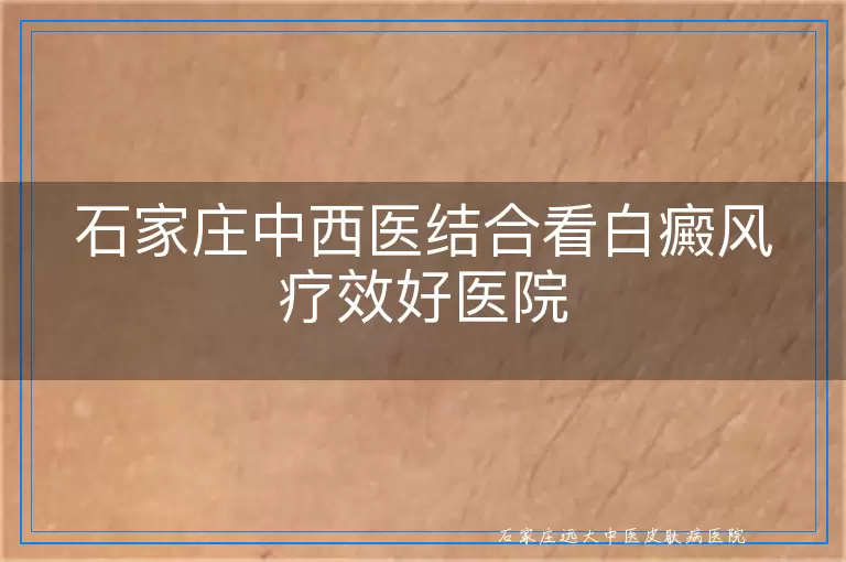石家庄中西医结合看白癜风疗效好医院