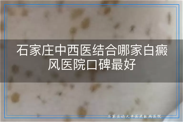 石家庄中西医结合哪家白癜风医院口碑最好