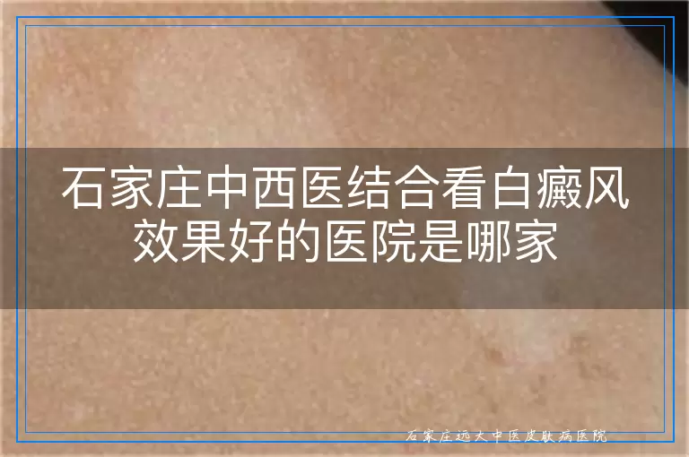 石家庄中西医结合看白癜风效果好的医院是哪家