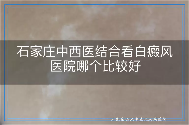 石家庄中西医结合看白癜风医院哪个比较好