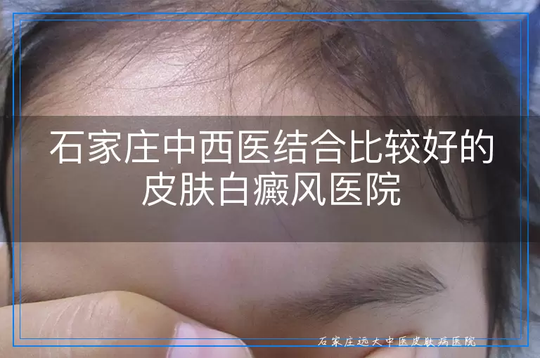 石家庄中西医结合比较好的皮肤白癜风医院