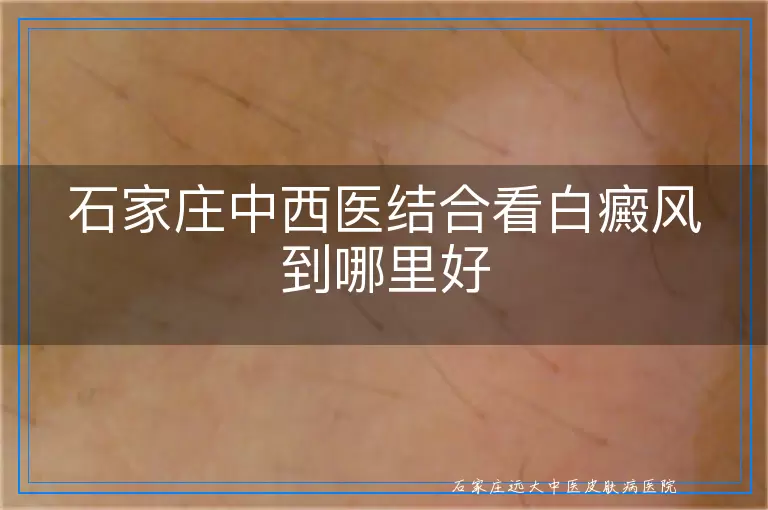 石家庄中西医结合看白癜风到哪里好
