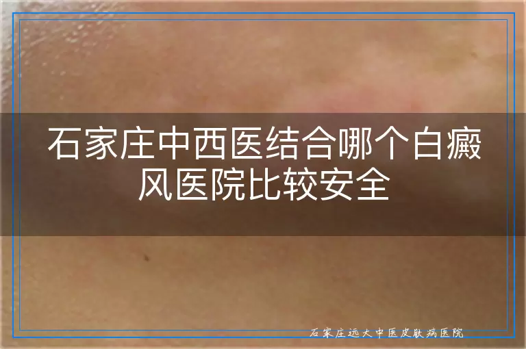石家庄中西医结合哪个白癜风医院比较安全