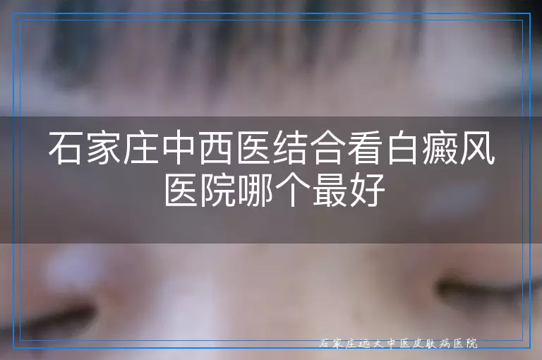 石家庄中西医结合看白癜风医院哪个最好