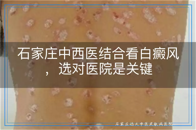 石家庄中西医结合看白癜风，选对医院是关键