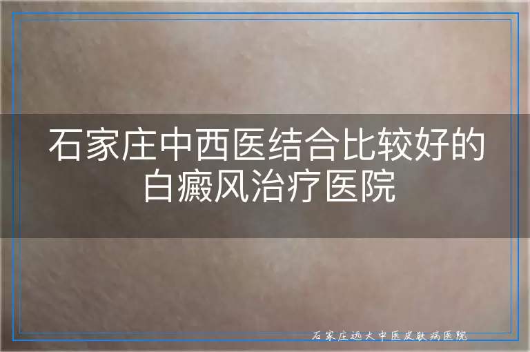 石家庄中西医结合比较好的白癜风治疗医院