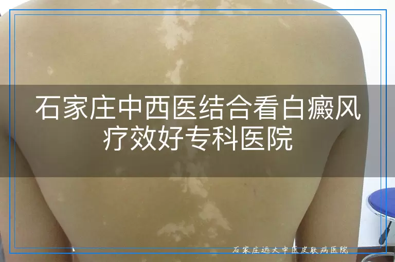 石家庄中西医结合看白癜风疗效好专科医院