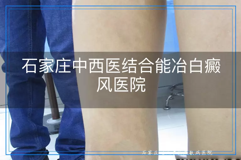 石家庄中西医结合能冶白癜风医院