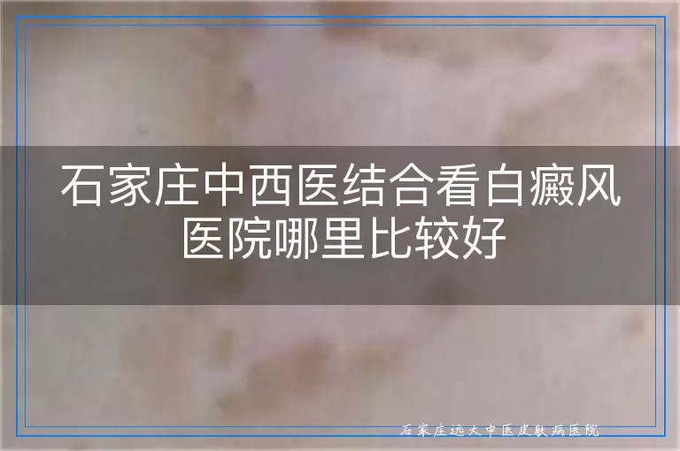 石家庄中西医结合看白癜风医院哪里比较好