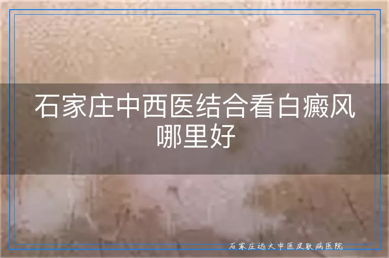 石家庄中西医结合看白癜风哪里好