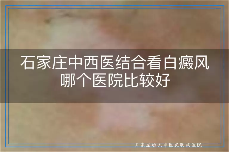 石家庄中西医结合看白癜风哪个医院比较好
