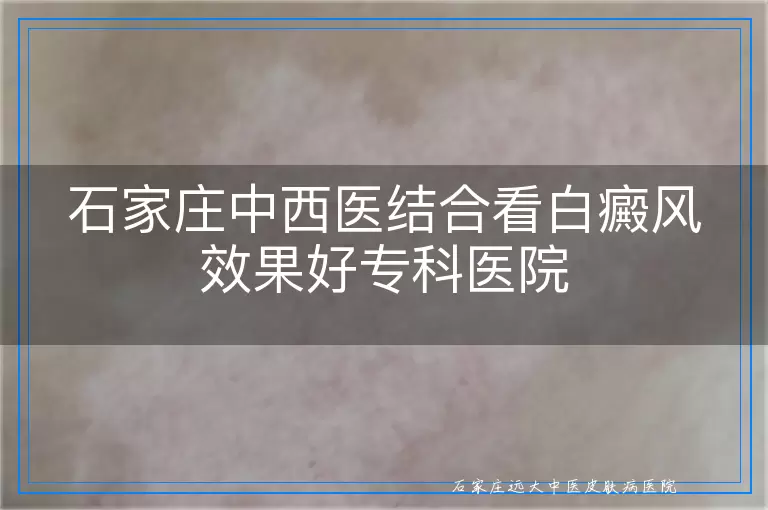 石家庄中西医结合看白癜风效果好专科医院