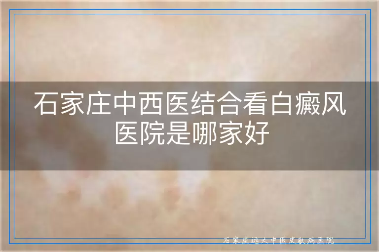 石家庄中西医结合看白癜风医院是哪家好