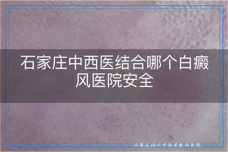 石家庄中西医结合哪个白癜风医院安全