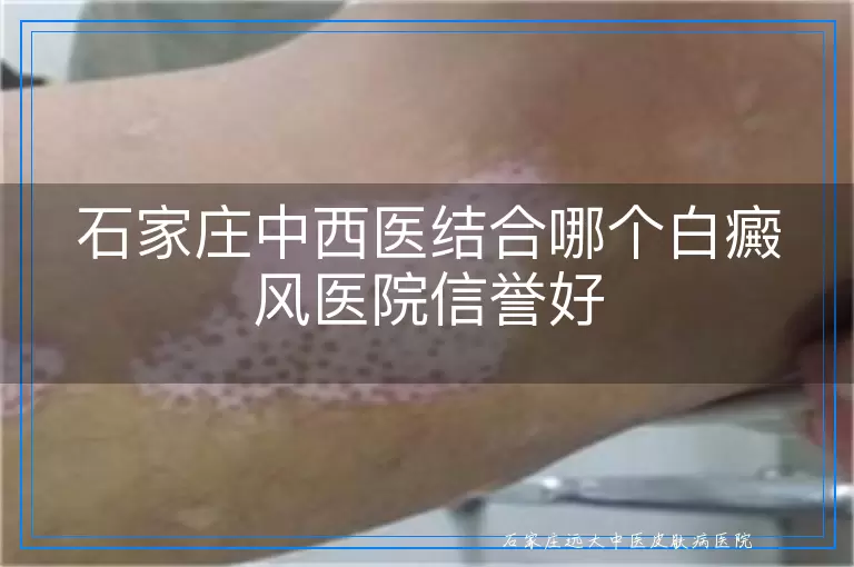 石家庄中西医结合哪个白癜风医院信誉好