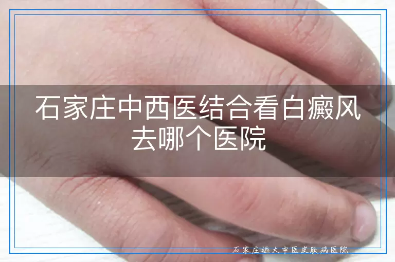 石家庄中西医结合看白癜风去哪个医院