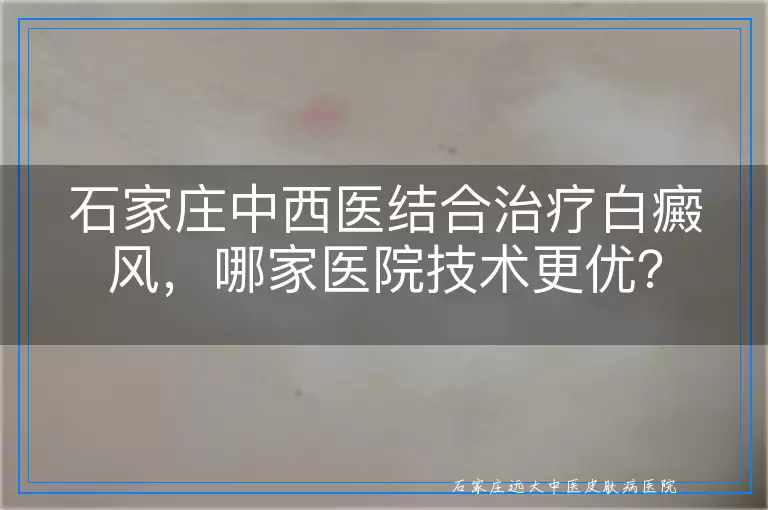石家庄中西医结合治疗白癜风，哪家医院技术更优？