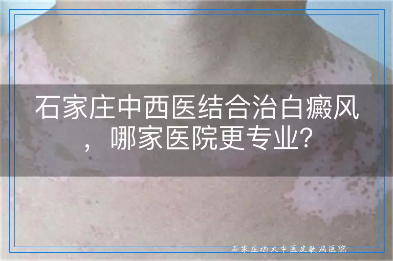 石家庄中西医结合治白癜风，哪家医院更专业？