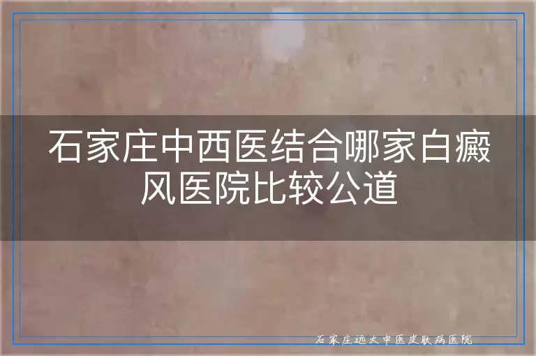 石家庄中西医结合哪家白癜风医院比较公道