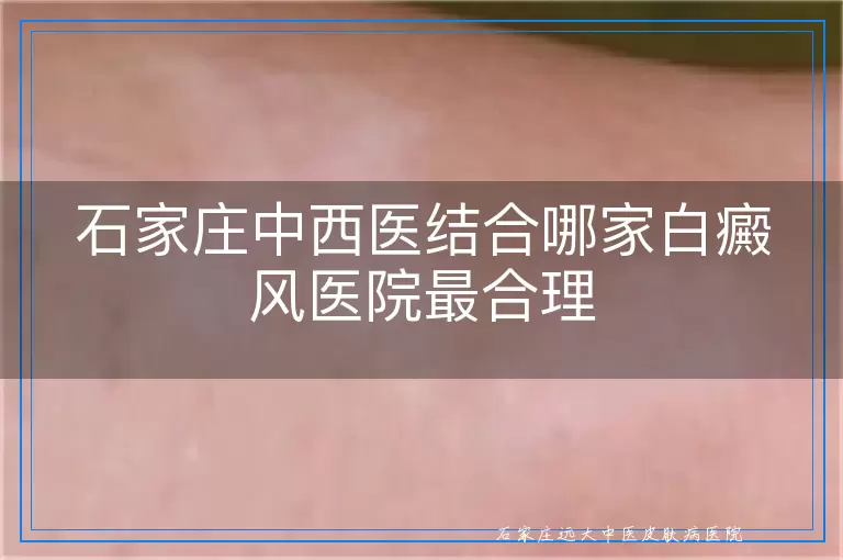 石家庄中西医结合哪家白癜风医院最合理