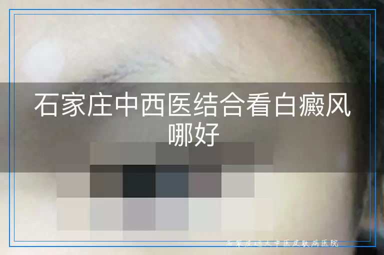 石家庄中西医结合看白癜风哪好