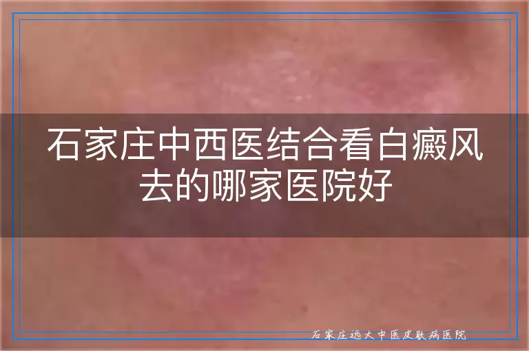 石家庄中西医结合看白癜风去的哪家医院好