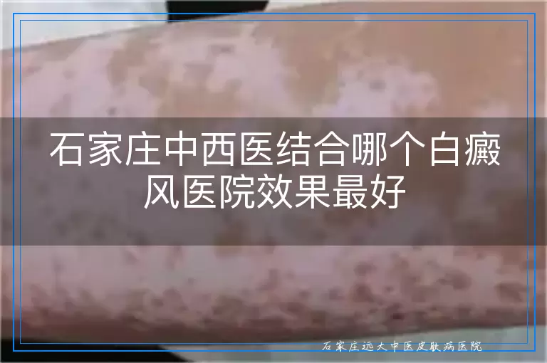 石家庄中西医结合哪个白癜风医院效果最好