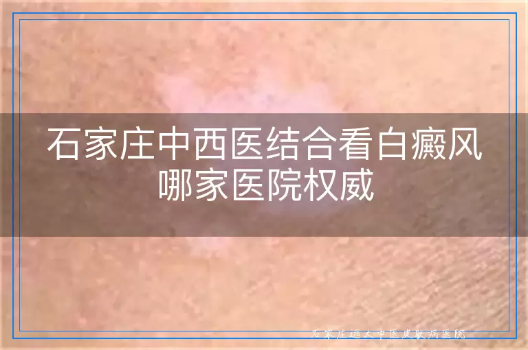 石家庄中西医结合看白癜风哪家医院权威