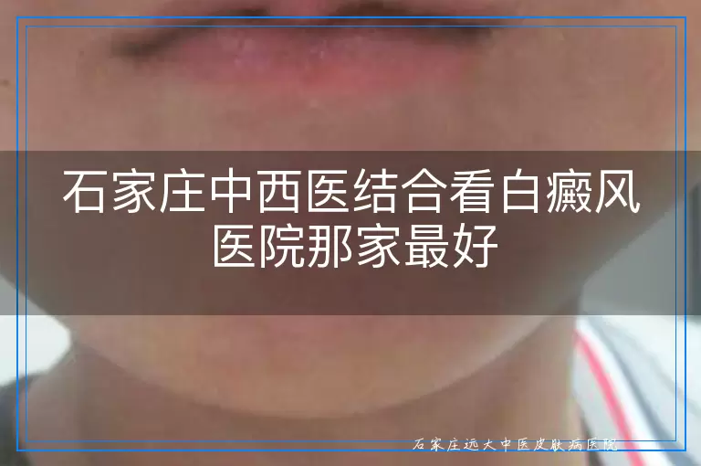 石家庄中西医结合看白癜风医院那家最好