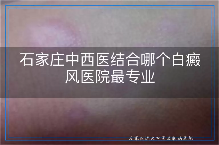 石家庄中西医结合哪个白癜风医院最专业