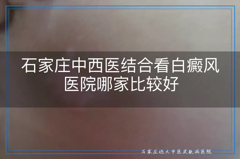 石家庄中西医结合看白癜风医院哪家比较好