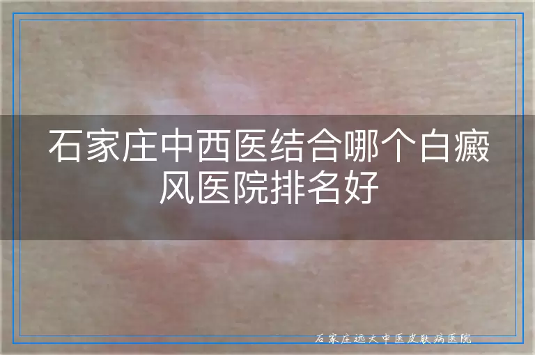 石家庄中西医结合哪个白癜风医院排名好