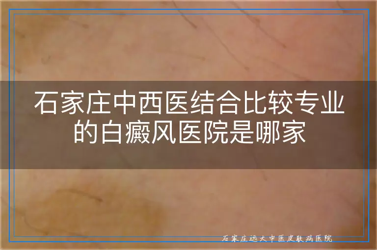 石家庄中西医结合比较专业的白癜风医院是哪家