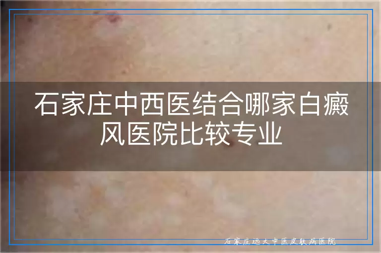 石家庄中西医结合哪家白癜风医院比较专业