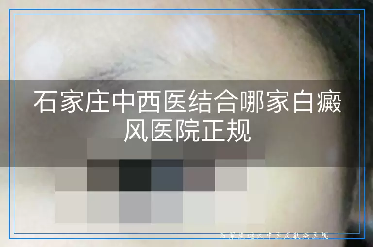 石家庄中西医结合哪家白癜风医院正规