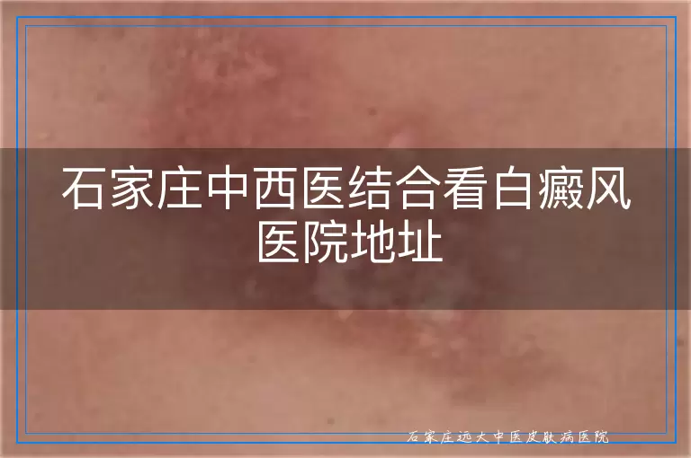 石家庄中西医结合看白癜风医院地址