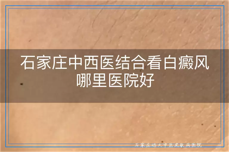 石家庄中西医结合看白癜风哪里医院好