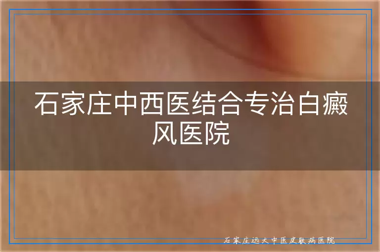 石家庄中西医结合专治白癜风医院