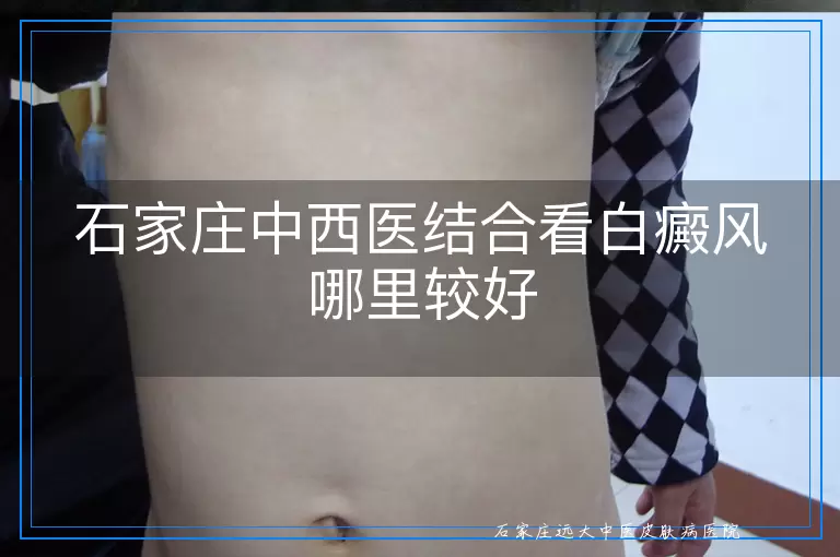 石家庄中西医结合看白癜风哪里较好