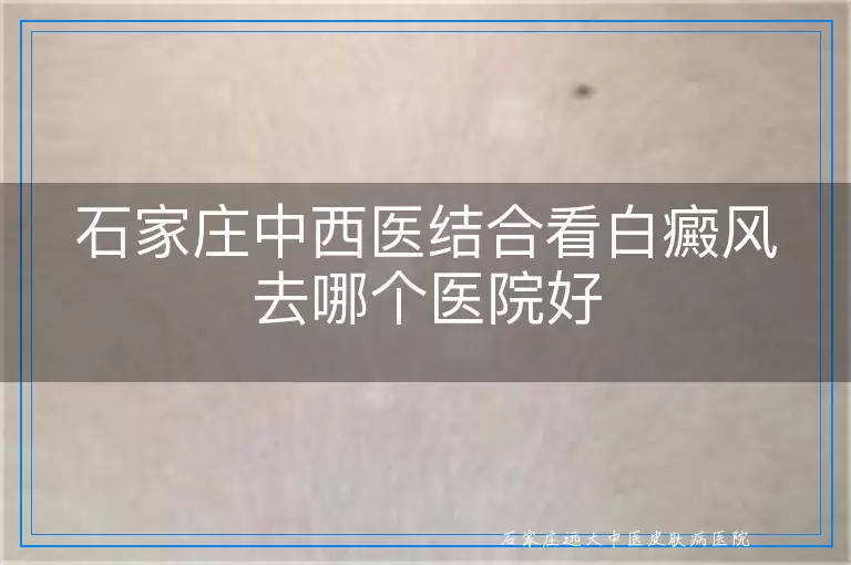 石家庄中西医结合看白癜风去哪个医院好