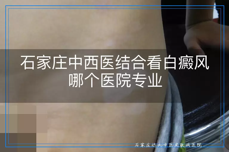 石家庄中西医结合看白癜风哪个医院专业