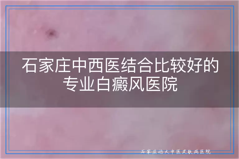 石家庄中西医结合比较好的专业白癜风医院