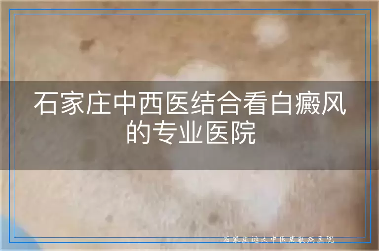 石家庄中西医结合看白癜风的专业医院