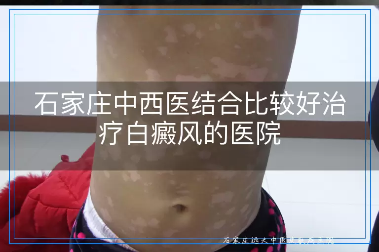 石家庄中西医结合比较好治疗白癜风的医院