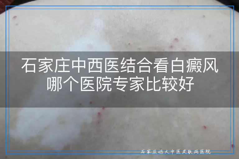 石家庄中西医结合看白癜风哪个医院专家比较好
