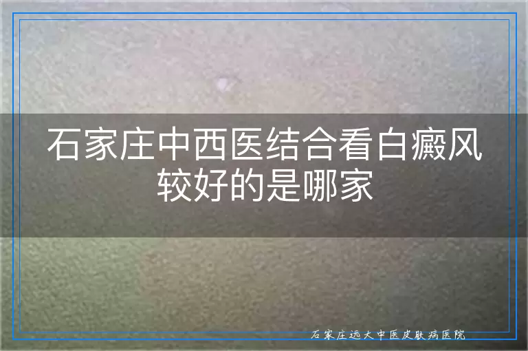 石家庄中西医结合看白癜风较好的是哪家