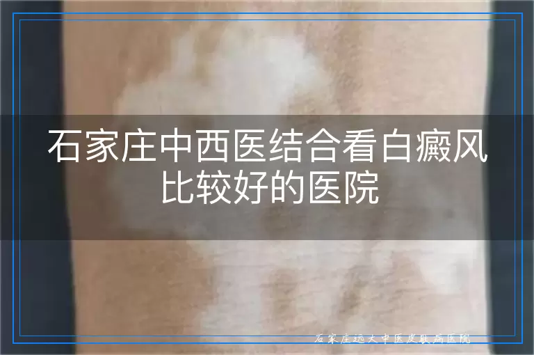 石家庄中西医结合看白癜风比较好的医院