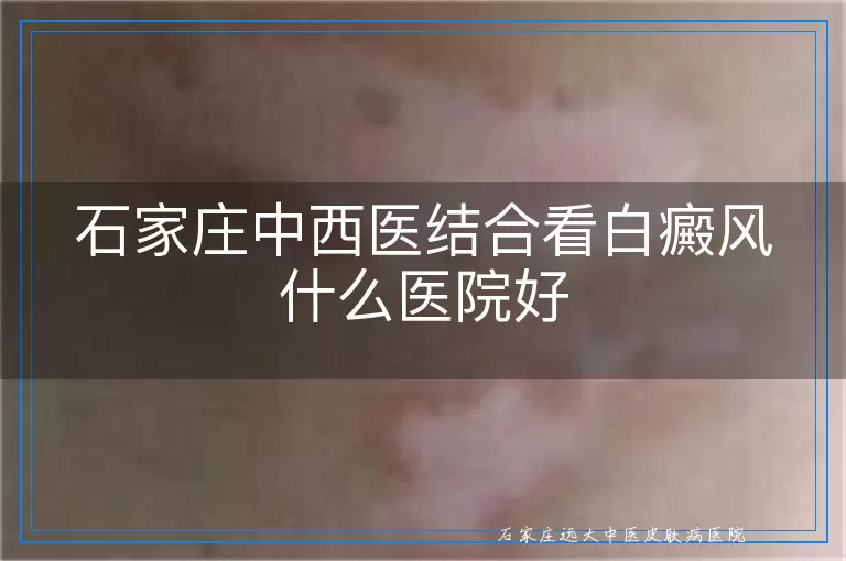 石家庄中西医结合看白癜风什么医院好
